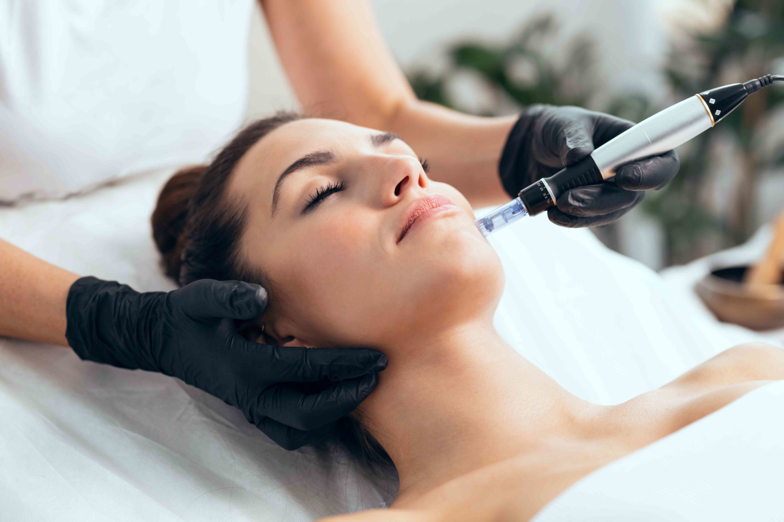 Young Woman Receiving PRP Microneedling Treatment | Willow Boutique Med Spa in Avon, OH