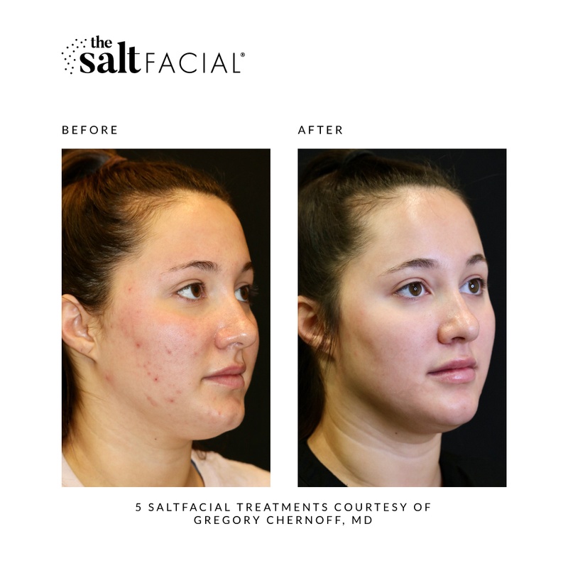 Saltfacial Before & After 1