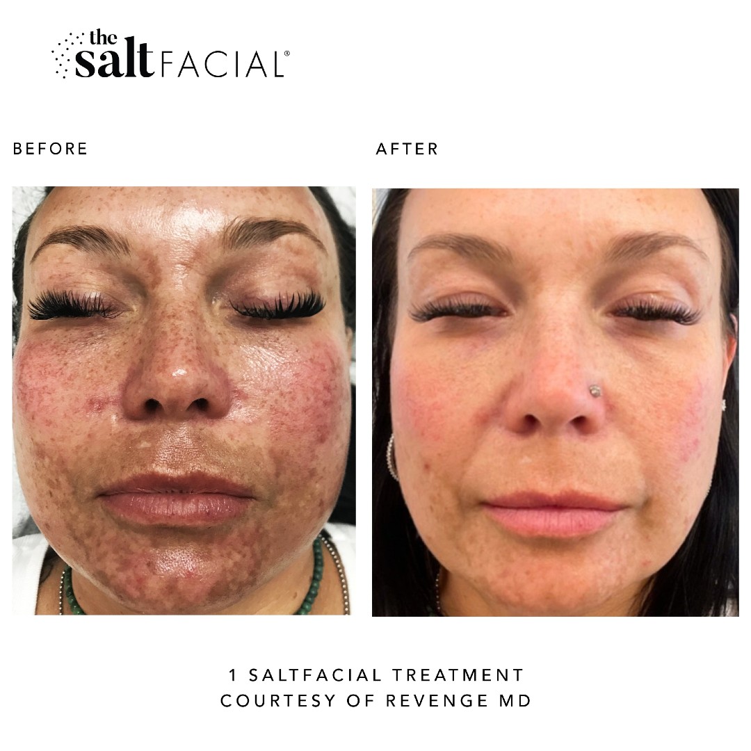 Saltfacial Before & After 2