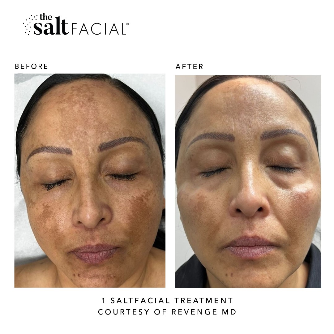 Saltfacial Before & After 6